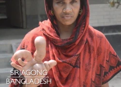 Bàn tay khổng lồ dị dạng của người phụ nữ Bangladesh