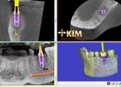 Cấy răng Implant, ghép xương, ghép nướu không đau