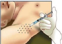 Chữa tăng tiết mồ hôi bằng Botox