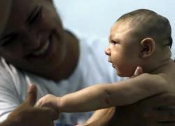 Có bằng chứng virus Zika tấn công làm teo não trẻ sơ sinh