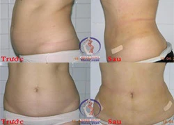 CoolLipo - công nghệ hút mỡ bằng laser