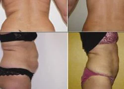 Hút mỡ bằng Laser Pharaon Lipo