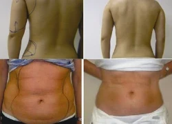 PharaonLipo Laser - khắc tinh của mỡ