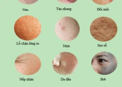 Trị nám sâu dễ dàng hơn nhờ chọn đúng cách