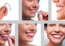 Invisalign - chỉnh nha với loạt khay trong suốt