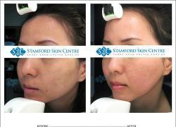 Stamford Skin Centre tự hào 10 năm với 15000 ca điều trị da thành công