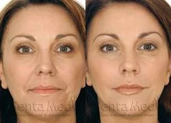 Xóa nhăn với Retylane hay Botox?