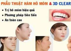 Kết hợp phẫu thuật hàm hô móm và niềng răng 3D Clear