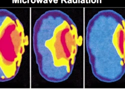 Sóng điện thoại có thể gây ưng thư não