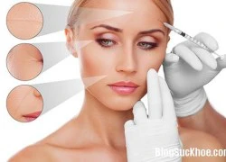 Tiêm filler và những điều cần lưu ý