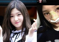 Chae Yeon (I.O.I) thừa nhận nâng mũi từ hồi lớp 10