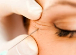 Những thắc mắc xoay quanh phương pháp tiêm botox căng da mặt