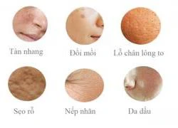 Phái đẹp và nỗi ảm ánh từ vết nám da