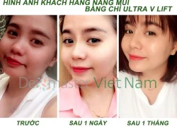 Sở hữu mũi cao thanh thoát một cách dễ dàng