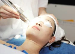 Trị nám da mặt bằng tia laser có an toàn không