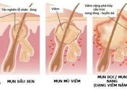 Vĩnh biệt mụn Làn da tươi tắn đón nắng hè