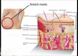 Làm thế nào để thoát khỏi vết rạn da