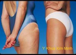 Cellulite &#8211; tình trạng da sần vỏ cam và cách chữa trị