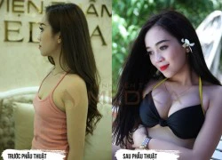 Nguyên nhân và cách khắc phục rãnh ngực rộng khi nâng ngực nội soi