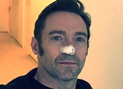 Hugh Jackman điều trị ung thư da lần thứ 5