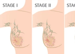 Phát hiện vắc-xin mới giúp điều trị ung thư vú