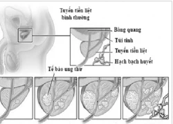 Hủy bỏ nội tiết tố nam, phái mạnh còn gì?