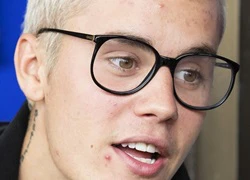 Justin Bieber lộ gương mặt nổi đầy mụn nhọt