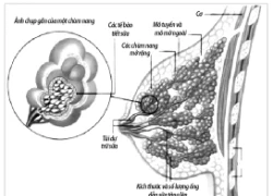 Tự khám vú là cách đơn giản nhất phát hiện ung thư vú