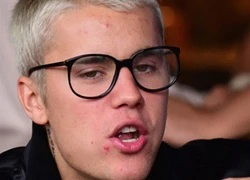 Justin Bieber bị nghiện nặn mụn trứng cá