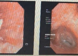 Sặc mề hột vịt lộn khiến cụ ông suýt chết