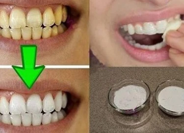 4 cách làm trắng răng hiệu quả, an toàn áp dụng ngay tại nhà