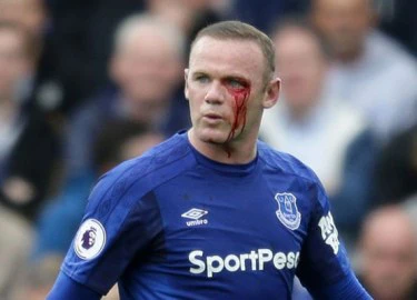 Rooney bị thúc cùi chỏ vào mắt, máu chảy đầm đìa