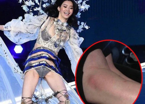 Lộ ảnh cổ chân sưng to, tấy đỏ của Ming Xi sau cú ngã "trời giáng" tại Victoria's Secret Fashion Show