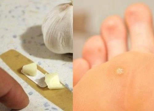 Đắp 3 "thần dược" này mỗi ngày, bạn sẽ không bao giờ biết đến mụn cóc ở chân là gì!