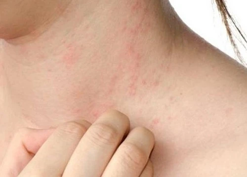 Đã mắc Rubella có mắc sởi nữa không?