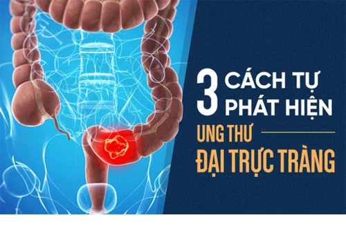 Cách tự kiểm tra ung thư đại trực tràng: Phát hiện sớm 3 tháng, có thể sống thêm 30 năm