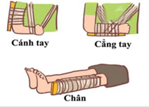 Hướng dẫn sơ cứu đúng cách cho trẻ bị gãy xương