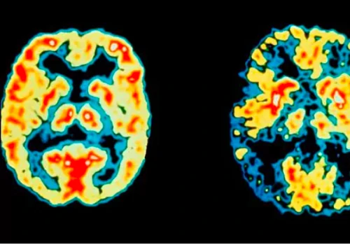 Lần đầu tiên vô hiệu hóa gen bệnh Alzheimer trong tế bào não người