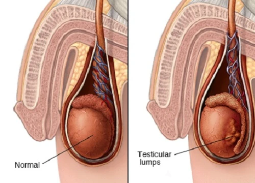 Nam giới dưới 35 tuổi nguy cơ cao bị ung thư tinh hoàn