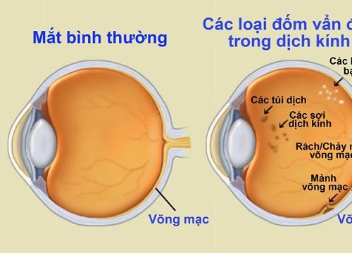 Biểu hiện ẩn đục dịch kính