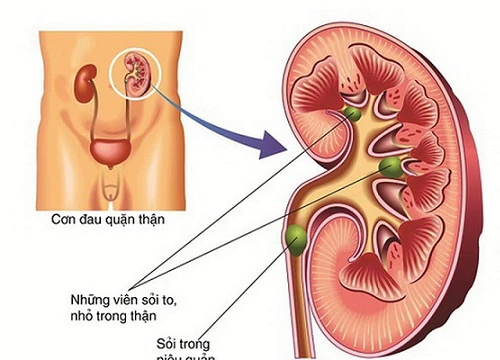 Biểu hiện thận ứ mủ