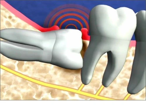 Biến chứng của răng khôn mọc lệch