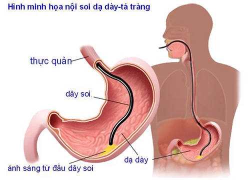 4 loại tổn thương dạ dày phổ biến có thể tiến triển thành khối u ác tính: Hãy biết sớm!