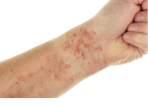 12 dấu hiệu cảnh báo bệnh lupus ban đỏ