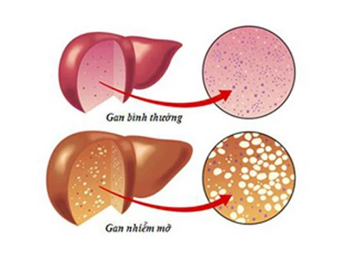 7 điều cần biết về gan nhiễm mỡ để cơ thể không gặp nguy hiểm