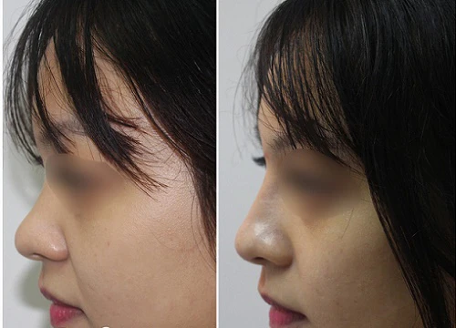 Những điều chị em nên biết khi làm đẹp bằng Filler