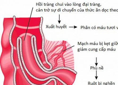 4 dấu hiệu chứng tỏ trẻ bị lồng ruột, cha mẹ cần lưu ý