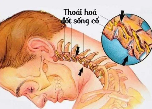 10 cấp độ thoái hóa đốt sống cổ: Hãy xem để biết bạn đang bị ở mức nào