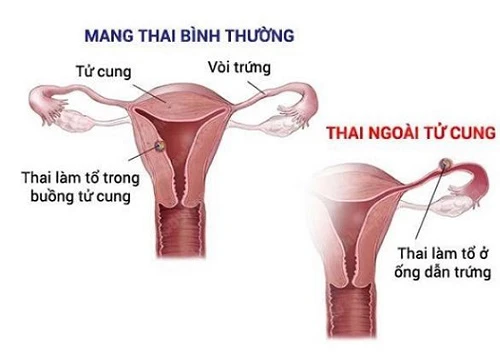 Những dấu hiệu mang thai ngoài tử cung phụ nữ nên biết