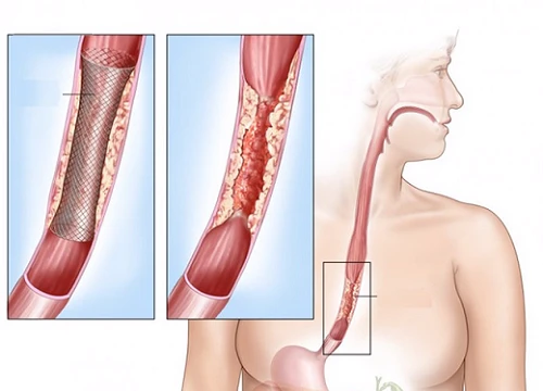 Tuyệt đối không mắc sai lầm này khi uống nước để tránh ung thư vòm họng, thực quản